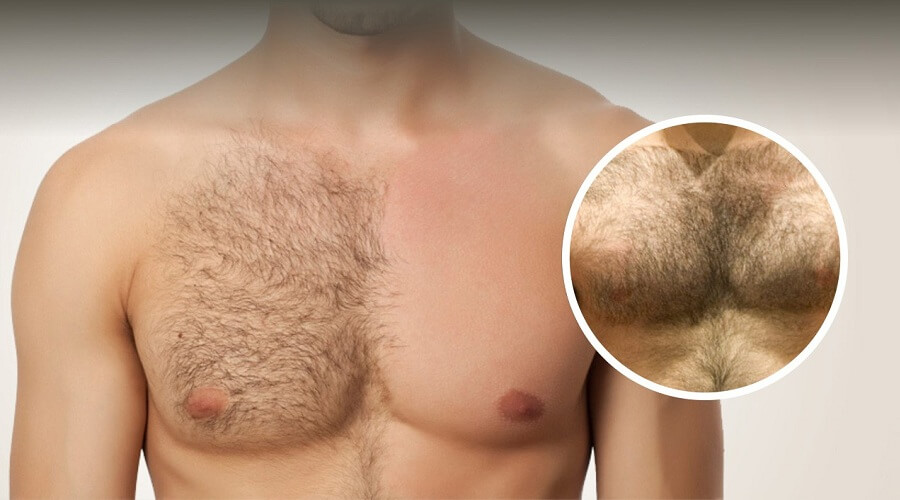 Body Hair Transplant